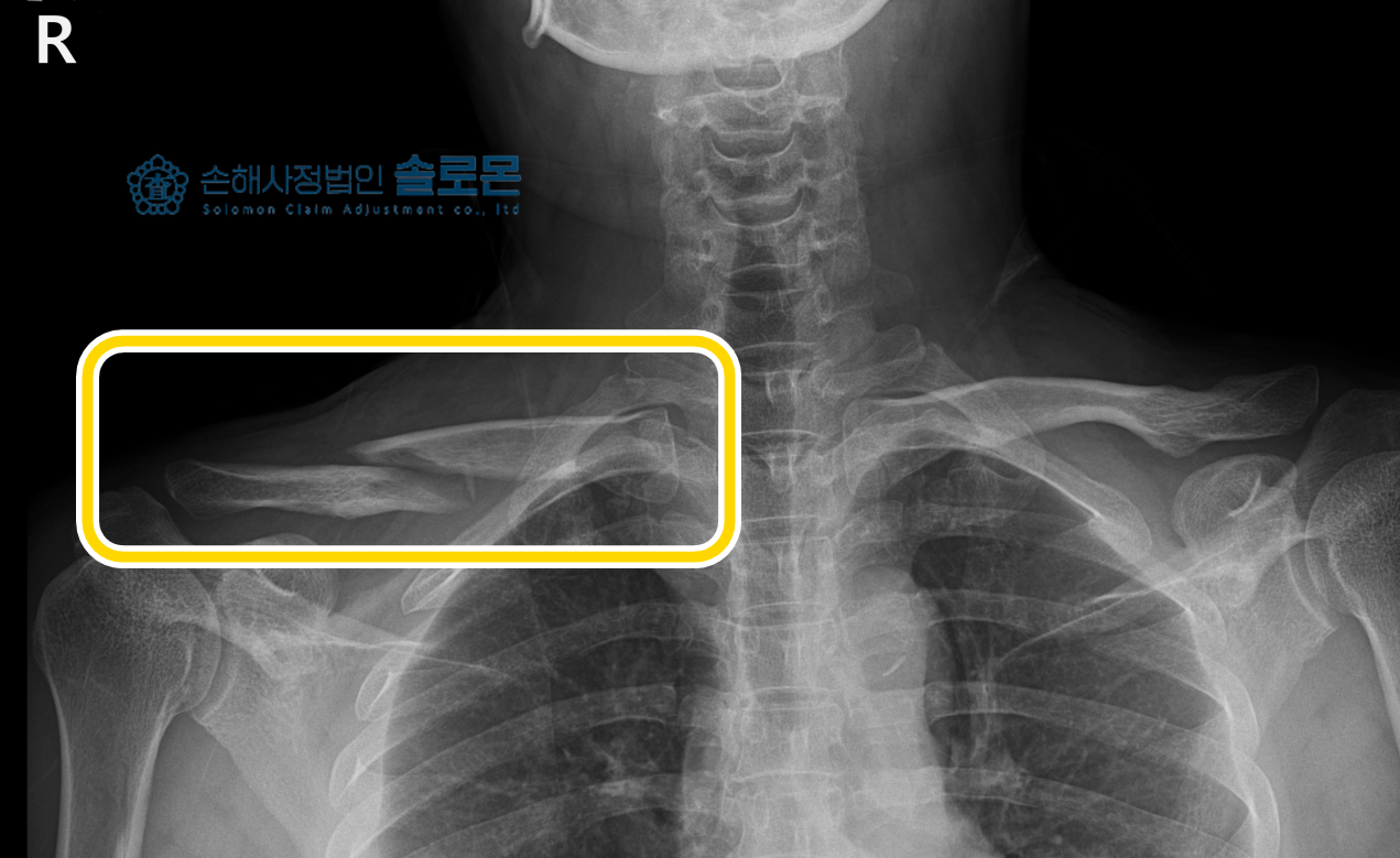 [S42040] 교통사고 쇄골골절 내 고정술을 하였다면 보상은