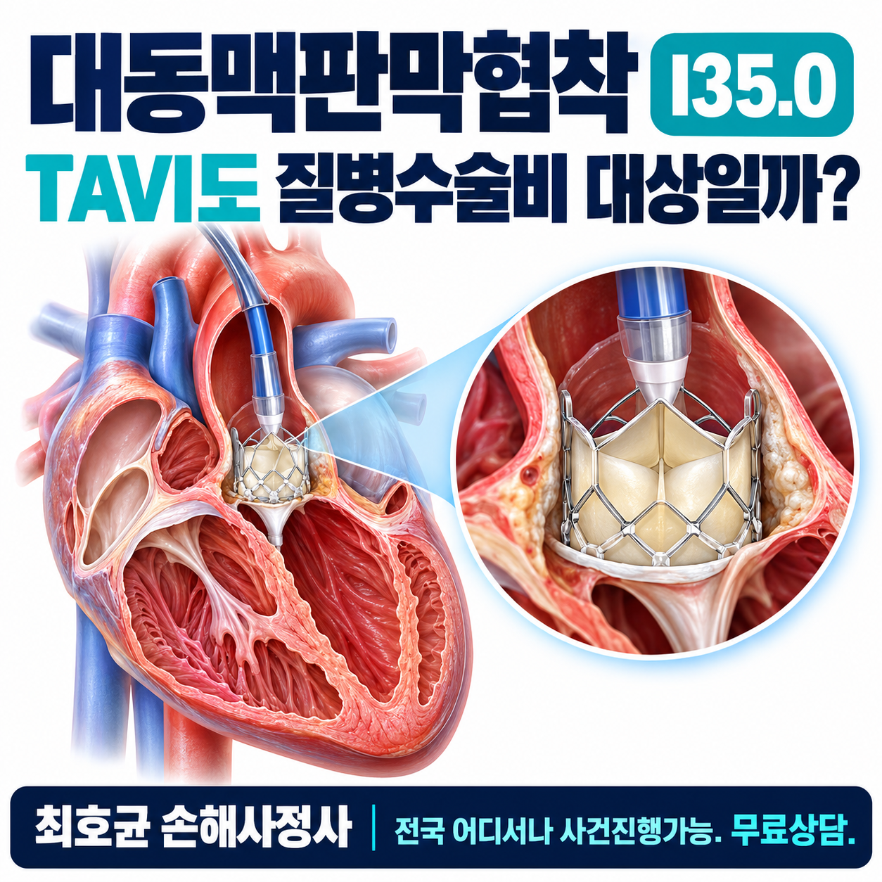 대동맥판막협착 I35.0, TAVI 시술도 질병수술비로 인정될까?