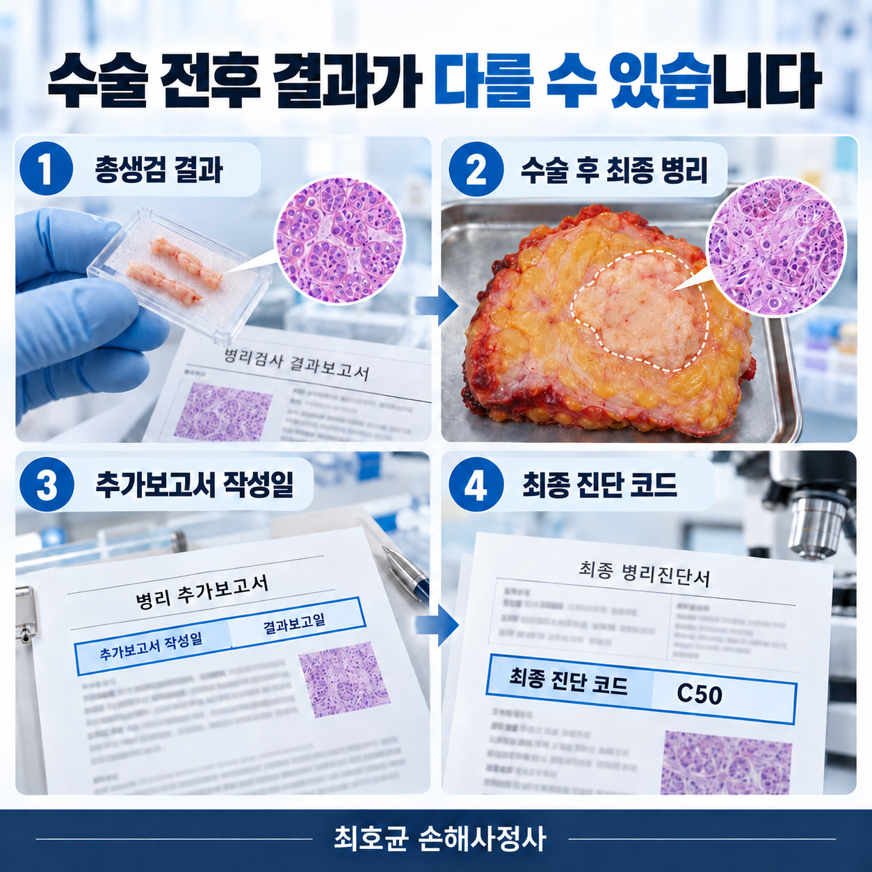 유방 미세침윤암 pT1mi, D05와 C50에 따라 일반암 진단비가 달라질까?